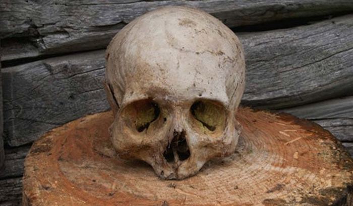 Трепанация черепа была известна ещё с древних времён.
