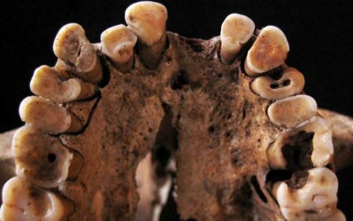 Древние тоже страдали от зубных проблем.