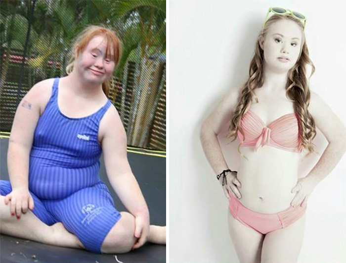 До и после похудения: 18-летняя Мэдлин Стюарт (Madeline Stuart) мечтает стать моделью