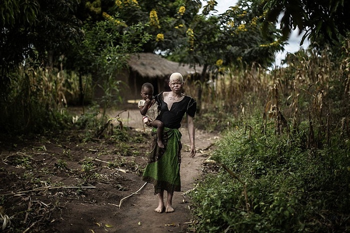Женщина-альбинос со своим обычным темнокожим ребенком.