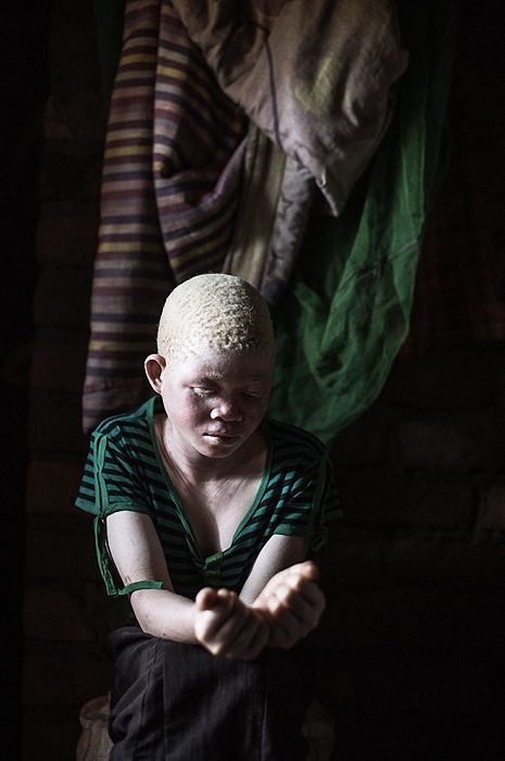 Catherine Amidu, 12-летняя девочка-альбиноска из Малави.