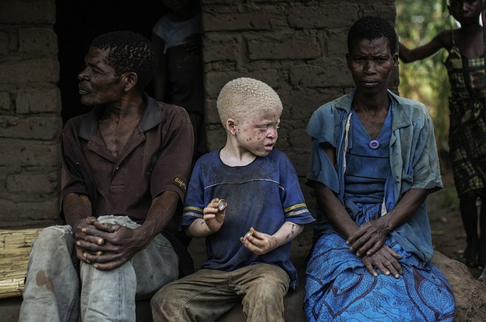Ребенок-альбинос сидит между обычными темнокожими родителями.