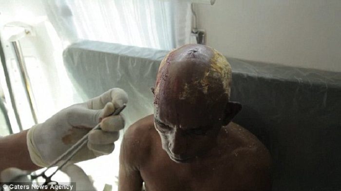 Травма, полученная вследствие разбивания кокоса об голову.