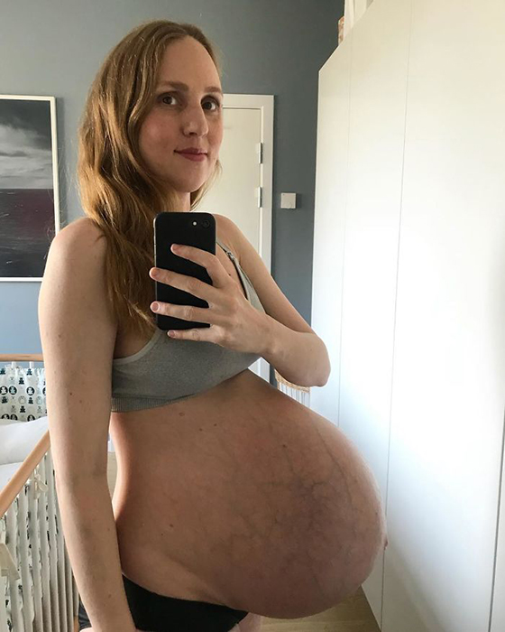 Датчанка беременна тройней.