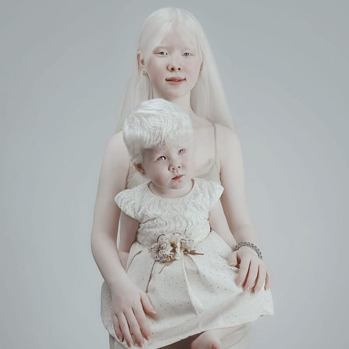 Родителям Асель и Камилы пришлось изучить суть явления альбинизм.