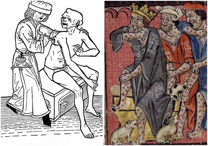 Слева направо: Чумной доктор, вскрывающий бубон, гравюра на дереве, 1482 год. \ На этой иллюстрации XIV века чума изображена как наказание.