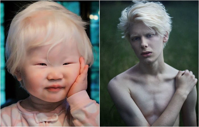 Люди-альбиносы в современном мире.