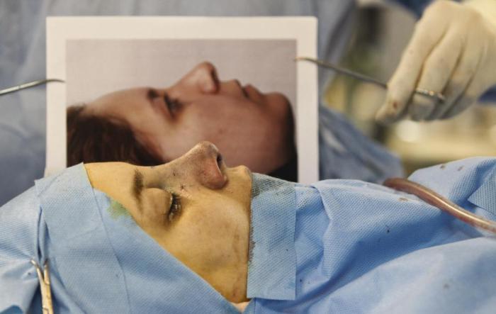 Иранский пластический хирург Али Манафи сравнивает фото носа пациентки до операции с полученным результатом.