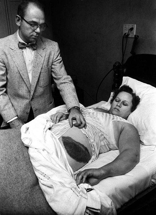 Мудди Якобз показывает гигантский ожог, который получила его пациентка Энн Ходжес вследствие падения метеорита 30 ноября 1954 года.