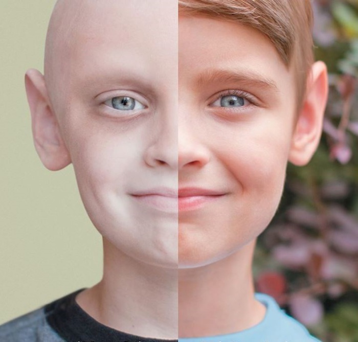 Мальчишка, сумевший побороть рак.
