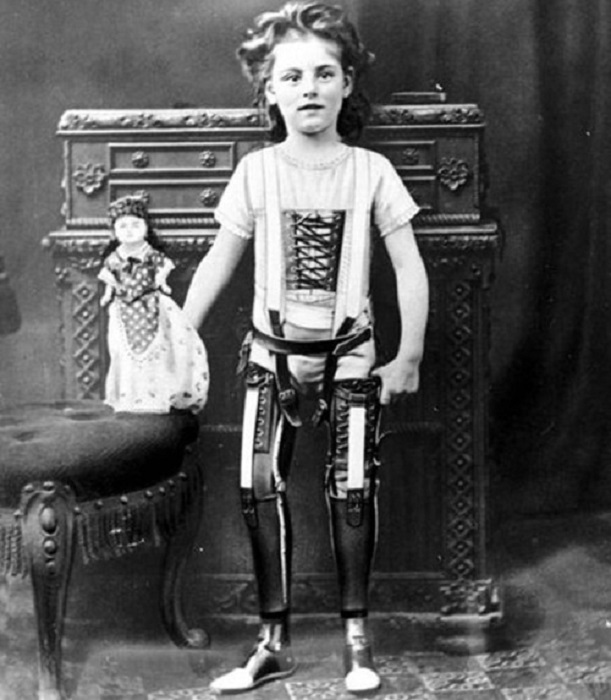 Протезирование ног - эта технология опередила свое время, 1900 год.
