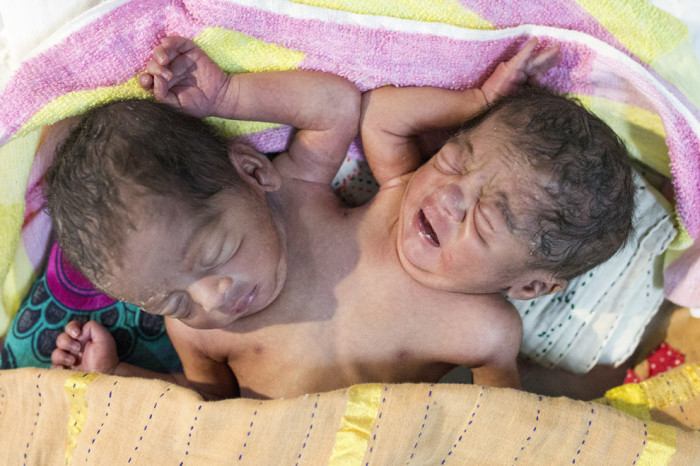 Сиамские близнецы, подброшенные в больницу столицы Бангладеш Дакке, 15 октября.