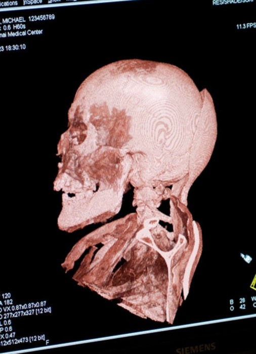Снимок компьютерной томографии черепа Михаила Орловица.
