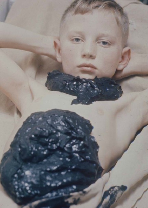 Лечение ребенка целебной грязью. Москва, 1970-е годы.