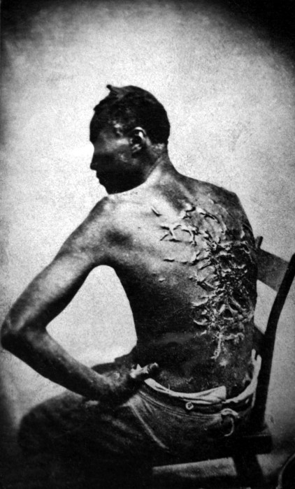 Бывший раб показывает свои шрамы от битья. США, штат Луизиана, 1863 год. 