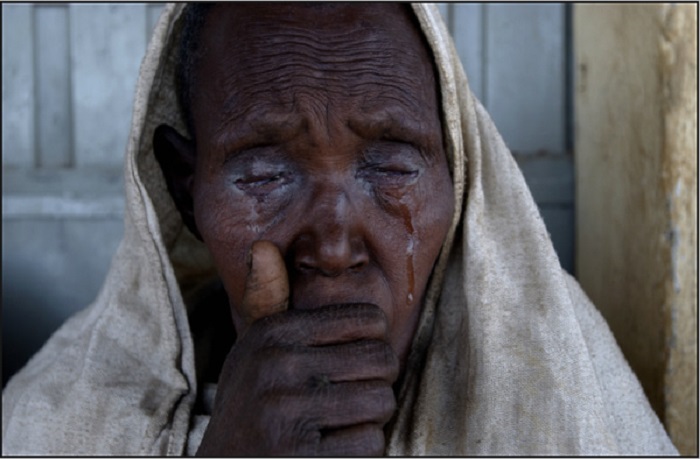 Пациент с трахомой. Эфиопия, 2005 год.