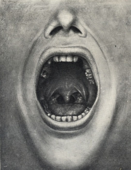 Иллюстрация ротовой полости пациента доктора Генри Коттона с удаленными зубами, 1921 год. | Фото: en.wikipedia.org.