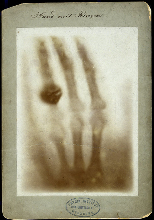«Рука с кольцом» Анны Рентген: первый рентгеновский снимок человека, 1895 год. | Фото: wellcomeimages.org.