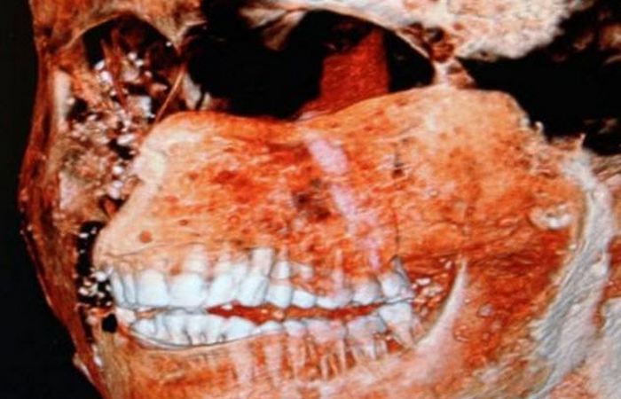 У жителей Помпей были здоровые зубы.