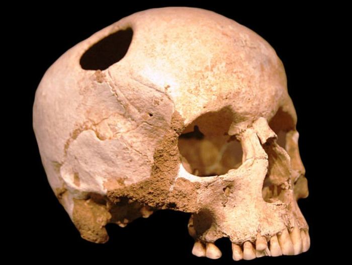 Трепанированный череп древнего человека.