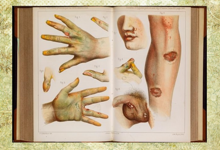Воздействие мышьяка на кожу. Иллюстрации из книги 1859 года.