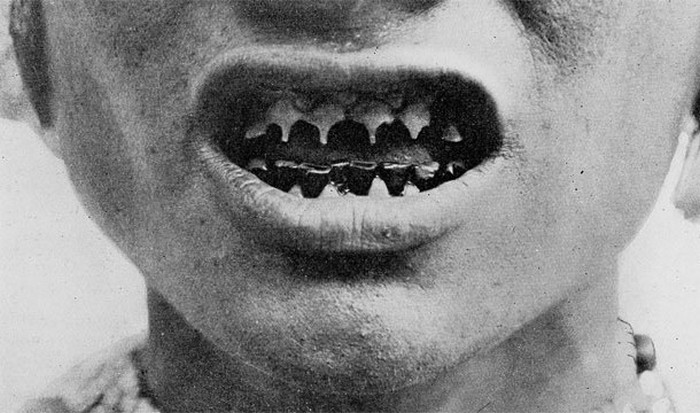 Заточенные зубы.